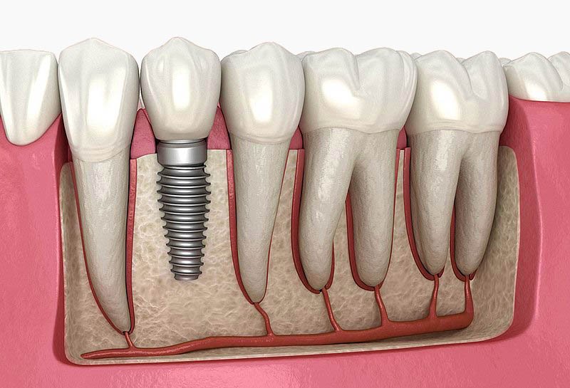 Dental implants India cost comparison — international patient at Muskaan Dentals Gurgaon