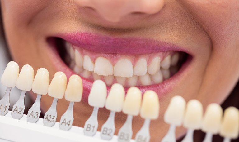 Digital Smile Design preview at Muskaan Dentals Gurgaon — smile makeover planned on screen before treatment