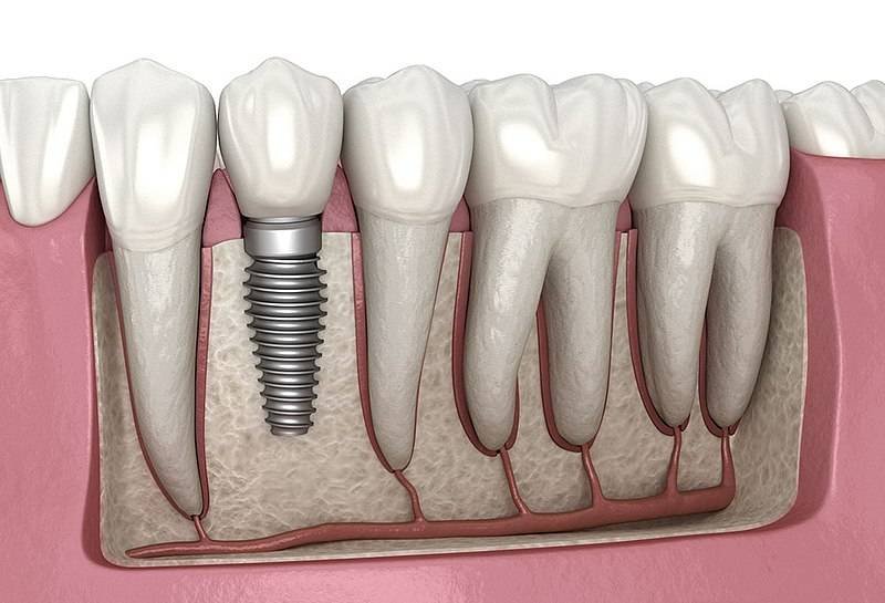 Osseointegration explained — how a dental implant fuses with jawbone at Muskaan Dentals Gurgaon