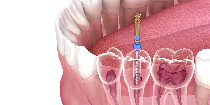 Dental implant after tooth extraction at Muskaan Dentals Gurgaon — same day implant option