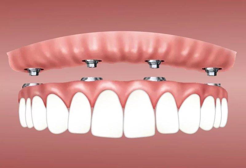 Dental implants for heart patients — safe treatment with cardiologist coordination at Muskaan Dentals Gurgaon