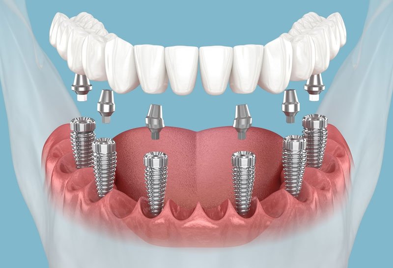 Dental implant risks and complications explained honestly at Muskaan Dentals Gurgaon