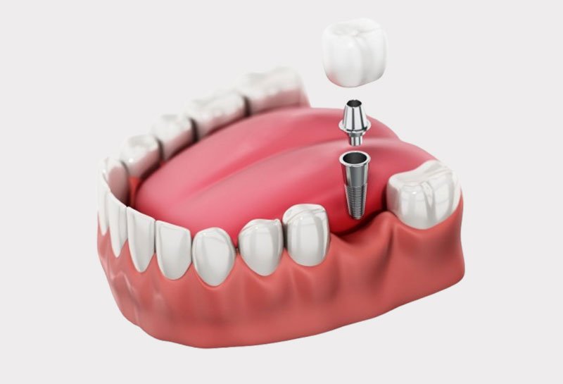 Dental implant eligibility assessment at Muskaan Dentals Gurgaon — who can get implants