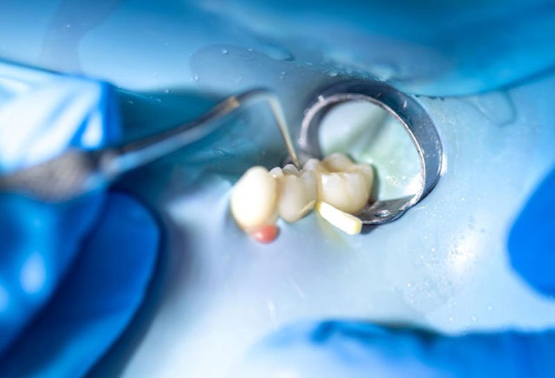Composite dental filling in Gurgaon at Muskaan Dentals