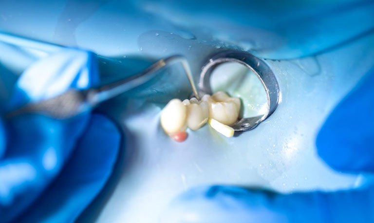 Composite filling in Gurgaon at Muskaan Dentals — tooth-coloured dental restoration by Dr. Suresh Ahlawat